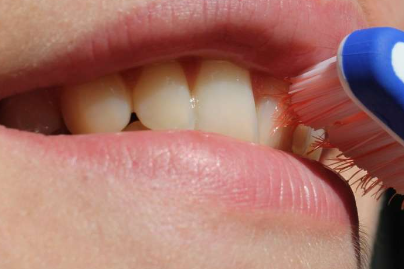 研究确定口腔细菌与脑脓肿之间的潜在联系