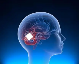 临床试验结果表明与植入式脑机接口相关的不良事件发生率较低