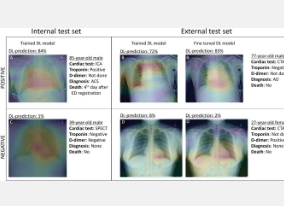 研究人员使用AI对胸痛患者进行分类