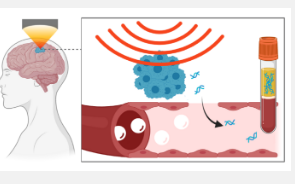 聚焦超声技术导致神经退行性疾病生物标志物的释放