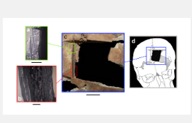 考古学家发现古代近东脑外科手术的早期证据