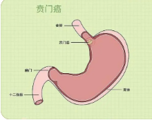 贲门癌的早期症状