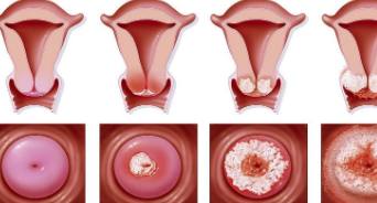 宫颈糜烂的治疗方法