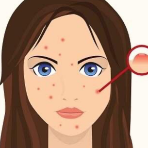 痤疮是一种常见的皮肤病
