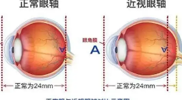 近视眼睛变形怎么办