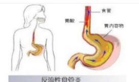 反流性食管炎症状表现有哪些