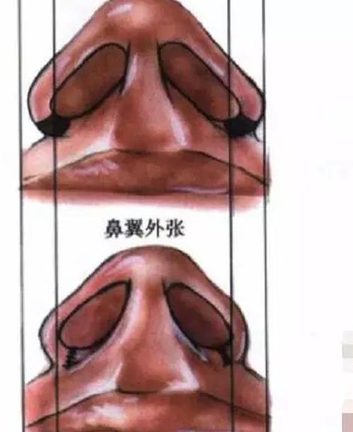 怎么瘦鼻翼，鼻头？ 怎样瘦鼻翼和缩小鼻头