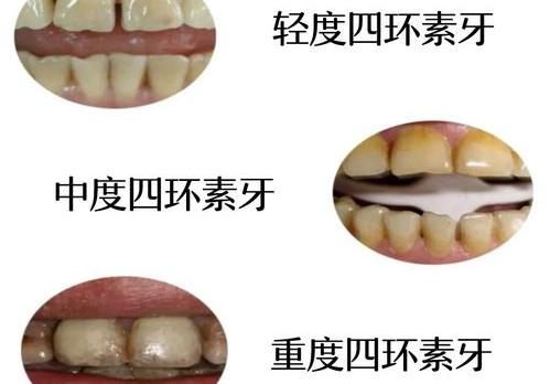 什么是四环素牙？ 四环素牙是什么