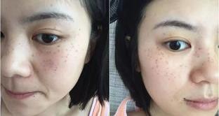 脸上长黄褐斑怎么才能去掉 脸上长黄褐斑怎么样才能去除
