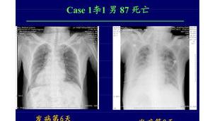 H7N9禽流感有哪些症状？？ h7n9禽流感的症状