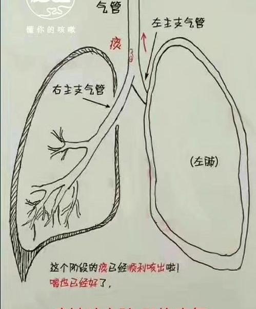 干咳无痰是什么原因造成的？ 干咳无痰是什么原因
