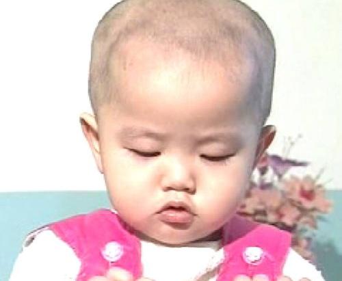 怎么判断孩子是否患有小儿佝偻病？ 佝偻病是什么病