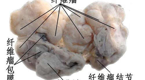 乳腺纤维瘤什么样的？ 乳腺纤维瘤