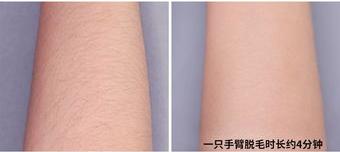 腋下永久脱毛多少钱？ 腋下脱毛一般需要多少钱