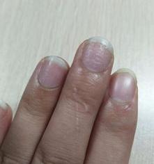 手指甲凹凸不平是怎么回事？ 指甲凹凸不平是什么原因
