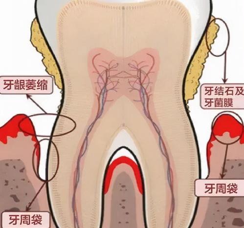 牙周炎引起的牙齿松动要全拨掉吗？ 牙周炎牙齿松动一定要拔掉吗