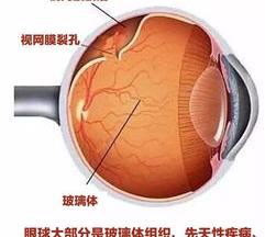 视网膜脱落会有什么症状？ 视网膜脱落的早期症状