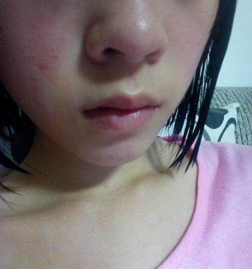 脸过敏如何处理才能够快速恢复？ 脸上过敏怎样快速消除