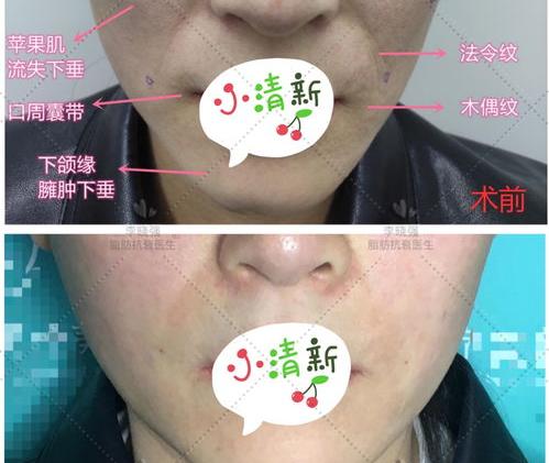 除皱针打后有副作用吗 注射除皱有哪些危害