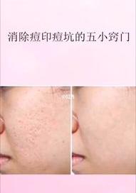 痘印怎么消除小妙招？ 怎样去痘印小妙招