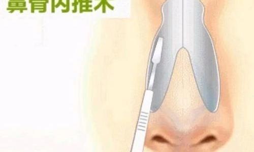 网曝鞠婧祎做了颧骨内推后遗症多，难怪她一口面包嚼32下，你怎么看？ 鼻骨内推前后对比照