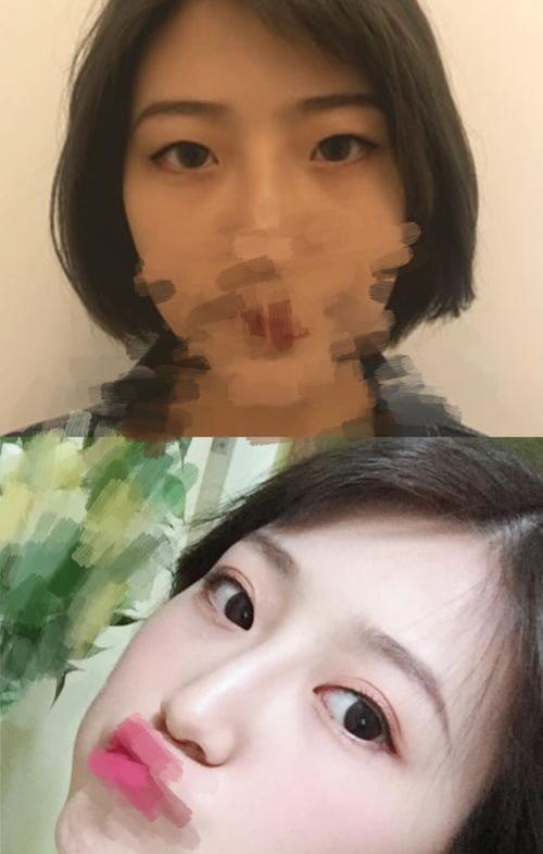 双眼皮哪里做的好 切双眼皮术医院哪家好