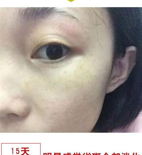 怎样去斑点小妙招最有效 怎么去除斑最简单最有效