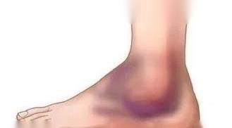 崴脚到什么程度才要去医院？ 崴脚程度级别图