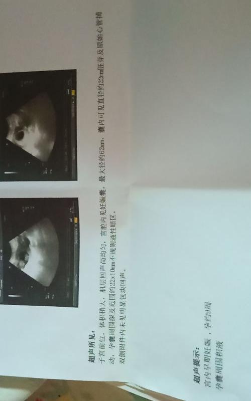 怀孕2个月打胎怎么打？ 怀孕两个月怎么打掉比较好