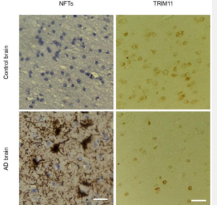 Tau调节蛋白被确定为开发阿尔茨海默病治疗的有希望的目标