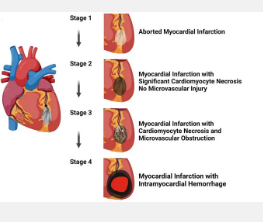 首次发布基于心肌损伤的心脏病发作四个阶段的分类