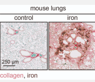 铁积累对纤维化疾病的新见解