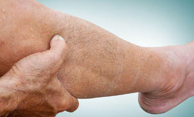下肢淋巴水肿患者患皮肤癌的风险增加