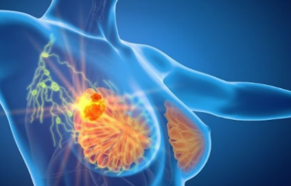 Enobosarm对ER阳性HER2阴性晚期乳腺癌具有抗肿瘤活性