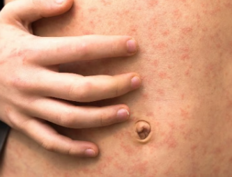 什么是麻疹我如何保护自己和家人